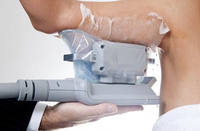 fat freezing arms Nantwich