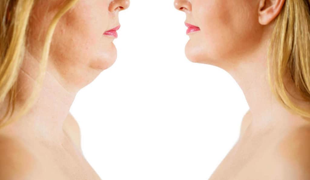 Double Chin treatment Nantwich before and after results