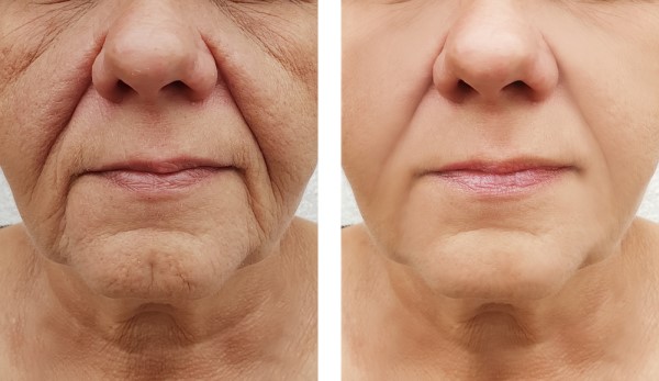 Learn more about Morpheus8 Treatment Nantwich today!