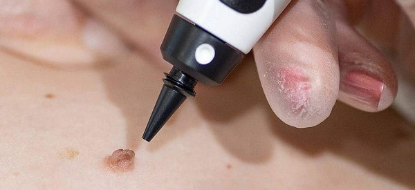 After Skin Tag Removal Nantwich