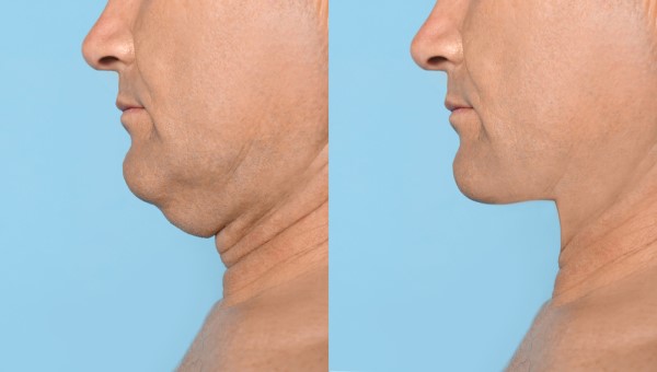 Which Non-Surgical Treatments Work Best for Jowls and Loose Skin Nantwich?