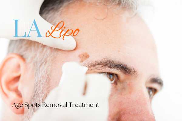 What Are the Most Effective Treatments for Age Spots Nantwich?