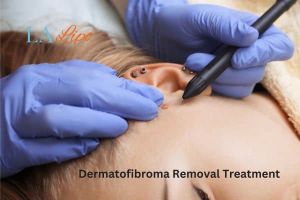 Dermatofibroma Removal Treatment Nantwich