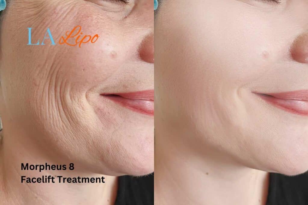 Morpheus8 Treatment Nantwich for flawless skin! Call us today!