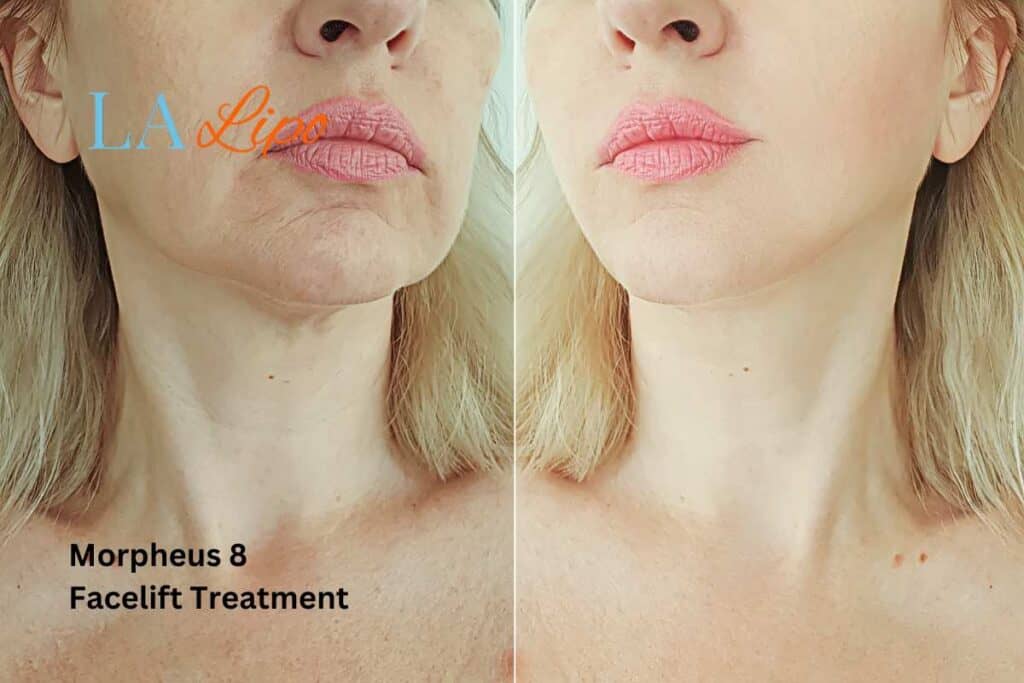 Turn back time with Morpheus8 Treatment Nantwich