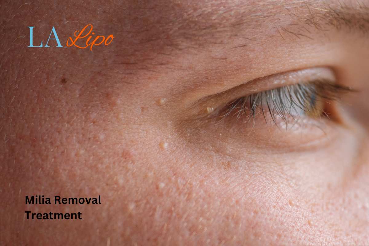 Cryopen Milia Removal: Is It the Easiest and Safest Option Nantwich?