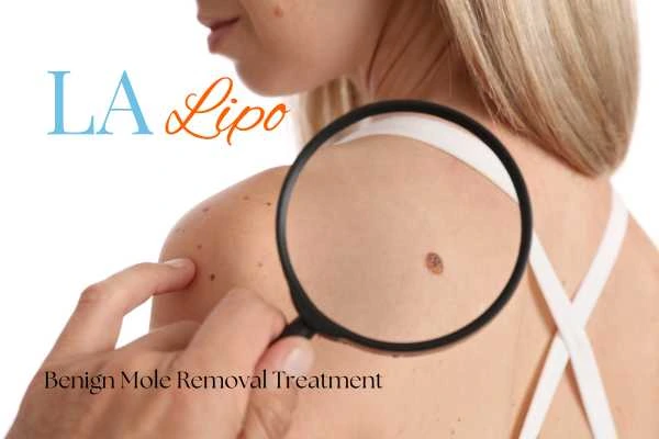 Woman having her inspection of blemish before mole removal Nantwich