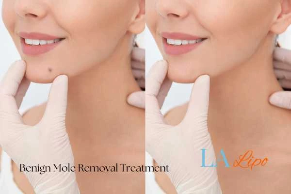 woman's before and after mole removal Nantwich results
