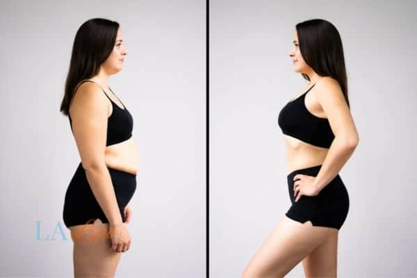 image of woman before and after results of LA-EMS Body Sculpting Nantwich to help treat Diastasis recti