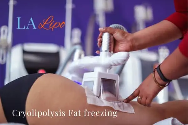 women getting fat freezing Nantwich