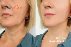 hi-fu for wrinkles Nantwich before and after results