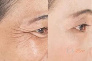 Before and after results of woman - HI-fu wrinkles reduction treatment Nantwich