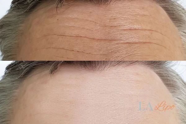results of HIFU Nantwich on mans forehead to help reduce lines and wrinkles