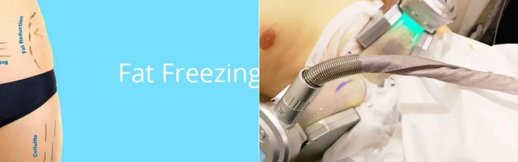 Fat freezing Nantwich on multiple areas of the body