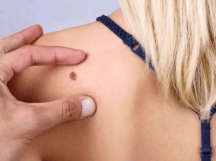 woman having mole removal Nantwich consultation before treatment.