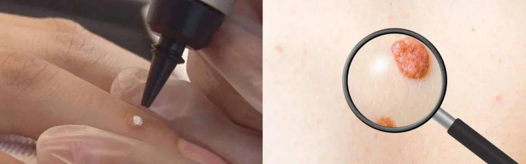 CryoPen practitioner Nantwich assessing a benign mole before treatment