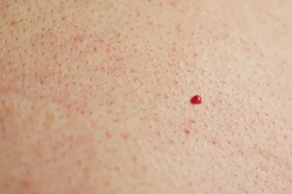close up of a cherry angioma Nantwich