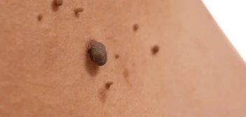image of a skin tag Nantwich