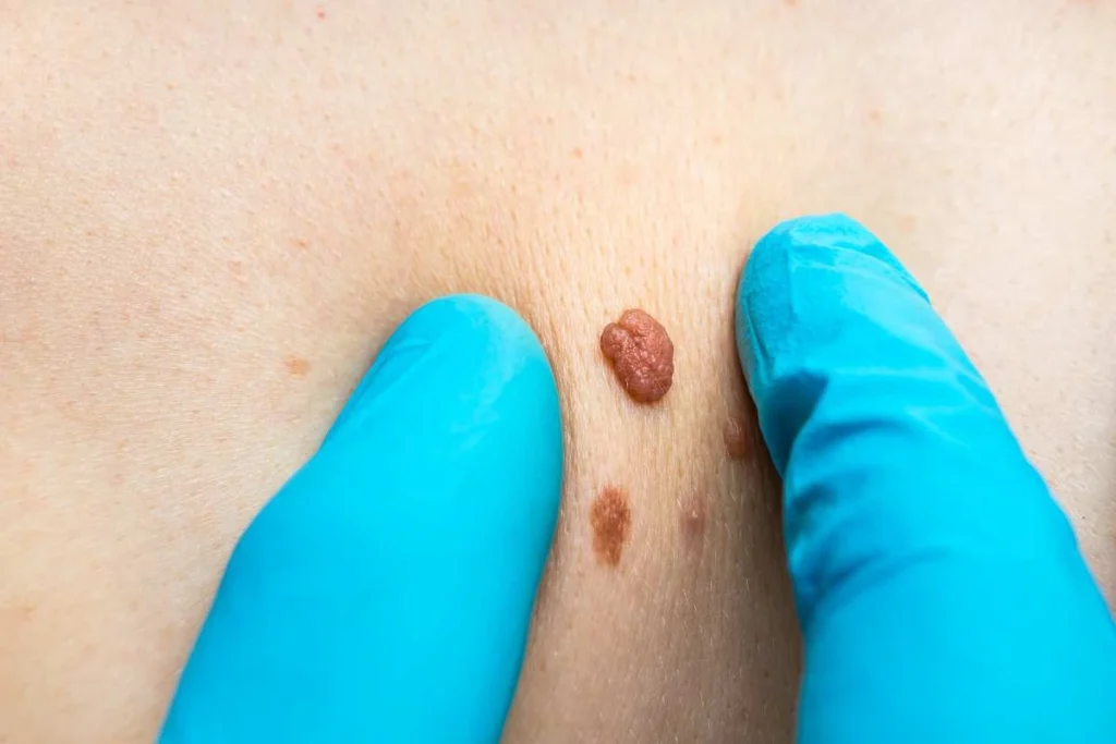 Consultant examining a skin tag Nantwich