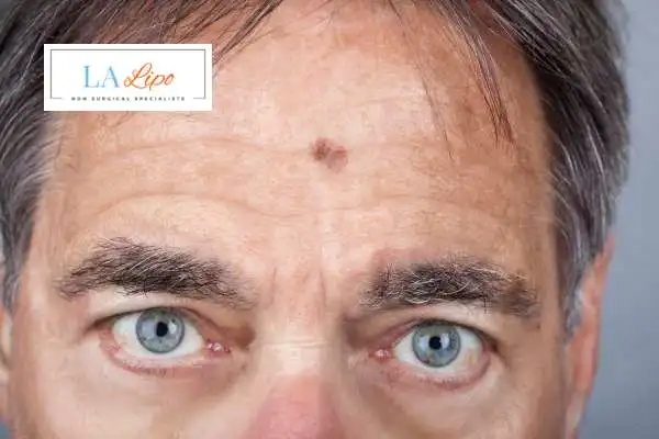 Solar Lentigo Removal Nantwich image of man with mark on his forehead