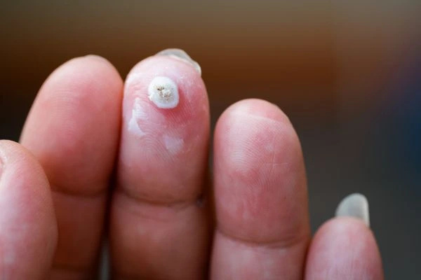 wart on person finger - cryotherapy to treat from LA LIPO Nantwich