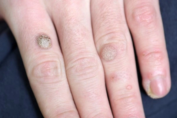 photo of warts on person hand - see wart removal Nantwich from LA LIPO