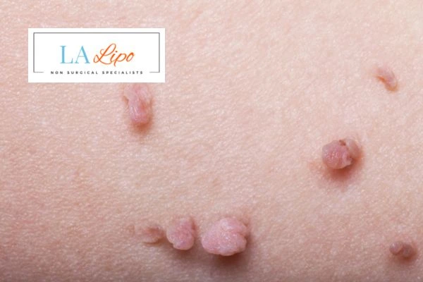 Does cryopen skin tag removal Nantwich hurt? Find out now call our team today!
