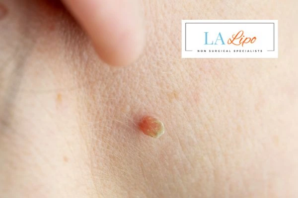 Book skin tag removal Nantwich today speak to our team now!