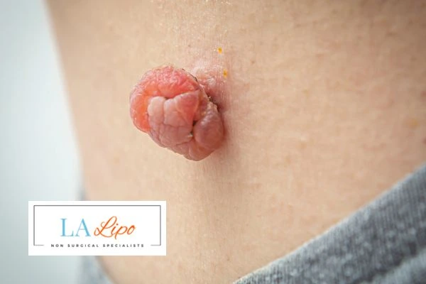 Interested in skin tag removal Nantwich? Concerned about the pain? Find out more today!
