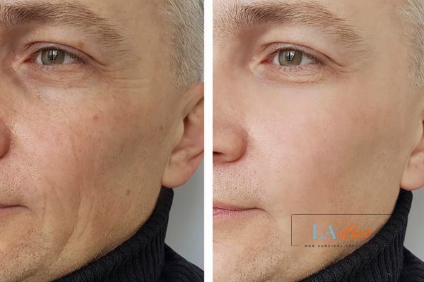 See the amazing results of Morpheus8 Treatment Nantwich!