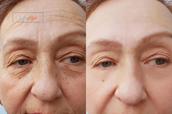 The powerful benefits of Morpheus8 Treatment Nantwich - Call Our team today!