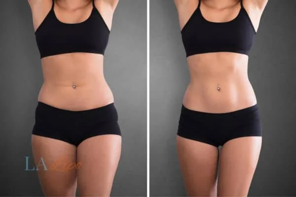before and after results of non-surgical treatment to help a woman's body image and mental health Nantwich