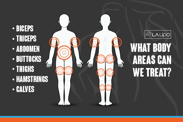 Diagram to show areas you can have LA-EMS Body Sculpting Treatment Nantwich