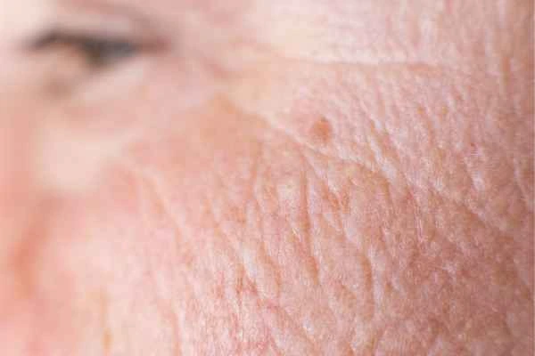 close up picture of a woman's face showing an age spot Nantwich