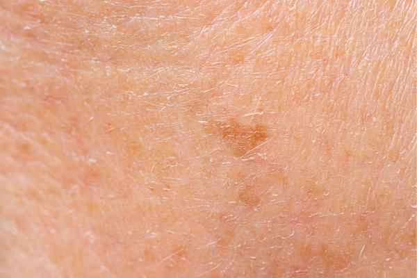 close up picture of age spots Nantwich