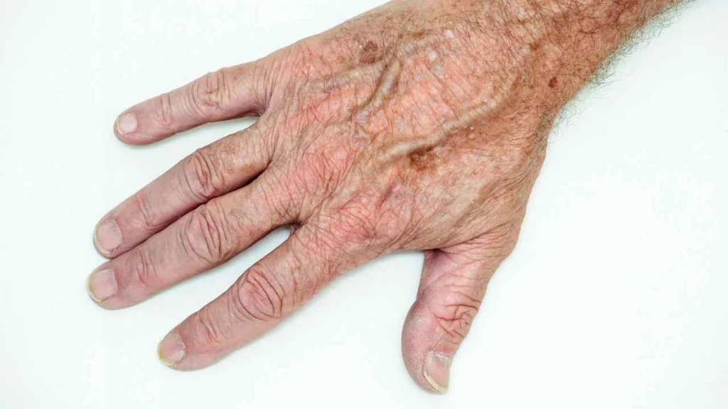 Male hand showing age spot Nantwich