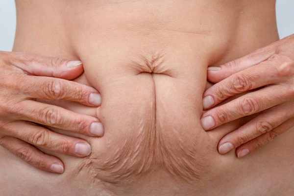 Image of a woman's stomach with loose skin - example of skin tightening Nantwich options