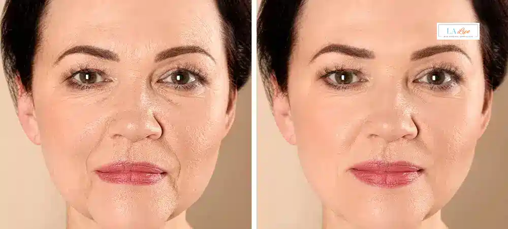 How Long Does It Take to See Results and How Long Do They Last Nantwich?