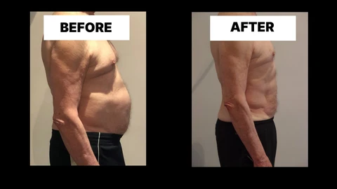 What Symptoms Can Diastasis Recti Cause in Men? Weak Core, Back Pain and Poor Posture Nantwich
